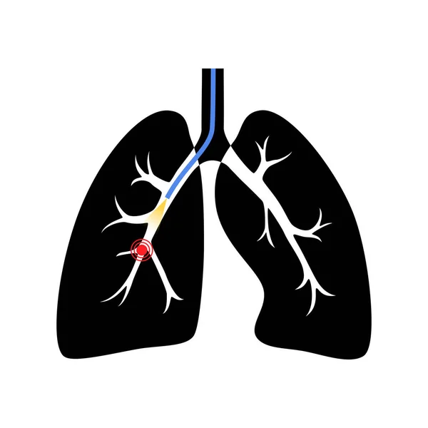 Bronkoskopi Pulmonolog Använder Ett Bronkoskop Genom Luftstrupen Lungan Sjukdomar Andningsorganen — Stock vektor
