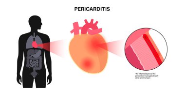 Perikardit anatomik poster. Kalp duvarı iltihabı. Göğüs ağrısı semptomu. İltihaplı iç organ konsepti. İnsan vücudunda viral enfeksiyon. Kardiyovasküler sistem medikal düz vektör çizimi