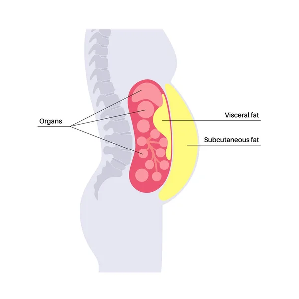 Viscerální Tlustý Lékařský Plakát Břišní Tuk Obklopuje Vnitřní Orgány Břišní — Stockový vektor