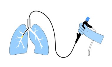 Bronkoskopi prosedürü. Pulmonolog nefes borusundan akciğere bronkoskop kullanıyor. Solunum sistemi hastalıkları ve tedavisi. Endobronşiyal ultrason bronkoskopi tanısal vektör çizimi