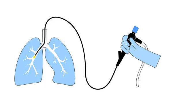 Bronkoskopi Pulmonolog Använder Ett Bronkoskop Genom Luftstrupen Lungan Sjukdomar Andningsorganen — Stock vektor