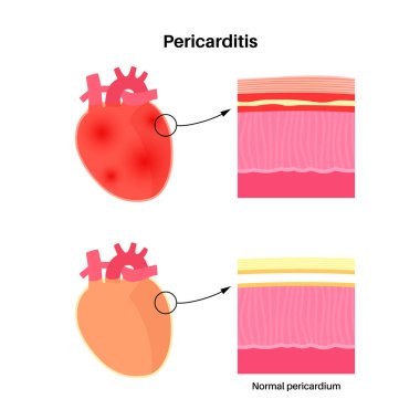 Perikardit anatomik poster. Kalp duvarı iltihabı. Göğüs ağrısı semptomu. İltihaplı iç organ konsepti. İnsan vücudunda viral enfeksiyon. Kardiyovasküler sistem medikal düz vektör çizimi