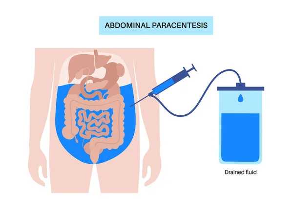 Abdominale Paracentese Procedure Vloeistof Buik Drain Ascitische Vloeistof Voor Diagnose — Stockvector