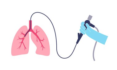 Bronkoskopi prosedürü. Pulmonolog nefes borusundan akciğere bronkoskop kullanıyor. Solunum sistemi hastalıkları ve tedavisi. Endobronşiyal ultrason bronkoskopi tanısal vektör çizimi