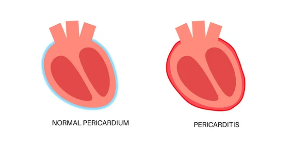 Cartaz Anatómico Pericardite Inflamação Parede Cardíaca Sintoma Dor Torácica Conceito —  Vetores de Stock