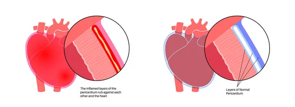 Affiche Anatomique Péricardite Inflammation Paroi Cardiaque Symptôme Douleur Thoracique Concept — Image vectorielle