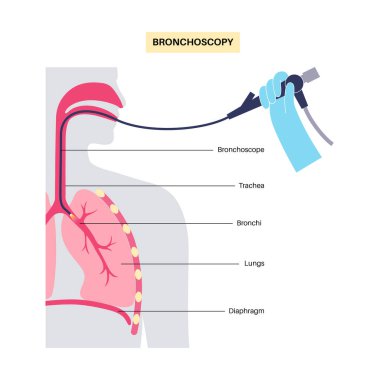 Bronkoskopi prosedürü. Pulmonolog ağızdan akciğere doğru bronkoskop kullanıyor. Solunum sistemi hastalıkları ve tedavisi. Endobronşiyal ultrason bronkoskopi tanısal vektör çizimi.