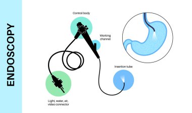 Gastroskopi prosedürü. Mide hastalıkları teşhisi. GERD, gastrit, sindirim sistemi iltihabı. Gastroenterolog gastroskop kullanıyor, endoskopi konsepti. Gastroenteroloji, gastrointestinal sorunlar