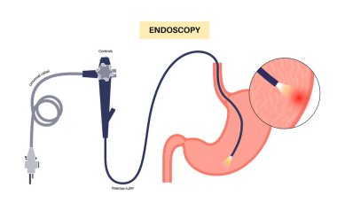 Gastroskopi prosedürü. Mide hastalıkları teşhisi. GERD, gastrit, sindirim sistemi iltihabı. Gastroenterolog gastroskop kullanıyor, endoskopi konsepti. Gastroenteroloji, gastrointestinal sorunlar