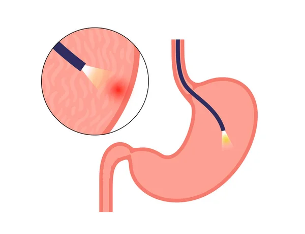 Gastroscopy Procedure Stomach Diseases Diagnostic Gerd Gastritis Digestive Tract Inflammation — Stock Vector