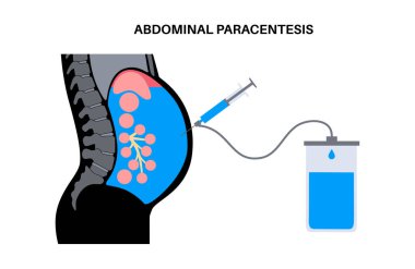 Abdominal parasentez prosedürü. Karında sıvı birikimi. Teşhis ya da terapi için asitik sıvıyı boşalt. Periton boşluğuna bir iğne ya da kateter sokulur. Göbek vektöründen fazla sıvıyı kaldır