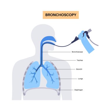 Bronkoskopi prosedürü. Pulmonolog ağızdan akciğere doğru bronkoskop kullanıyor. Solunum sistemi hastalıkları ve tedavisi. Endobronşiyal ultrason bronkoskopi tanısal vektör çizimi.