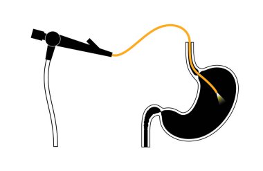 Gastroskopi prosedürü. Gastroenterolog gastroskop kullanıyor. Mide ve onikiparmak bağırsağı taraması. Gastroenteroloji, endoskopi ve mide hastalıkları. Sindirim sistemi enfeksiyonu ve tedavi vektörü