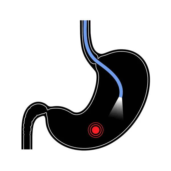 Gastroscopy Procedure Stomach Diseases Diagnostic Gerd Gastritis Digestive Tract Inflammation — Stock Vector