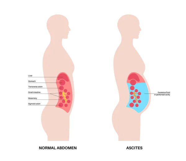 Asitlerin Anatomisi Periton Boşluğunda Sıvı Var Karın Şişkinliği Ağrı Şişkinlik — Stok Vektör