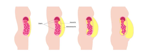 Viszeralfett Medizinisches Poster Bauchfett Umgibt Die Inneren Organe Bauchraum Krankheitskonzept — Stockvektor
