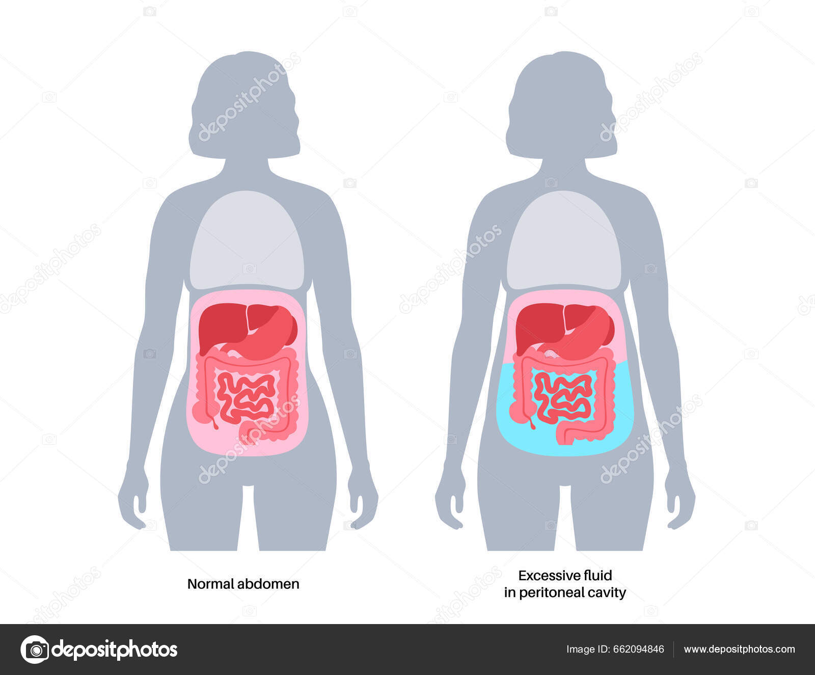 Ascites Anatomy Fluid Peritoneal Cavity Abdominal Distension Pain Ascites Anatomy Fluid Peritoneal Cavity Abdominal Distension Pain