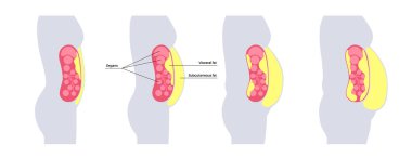 İçsel şişman tıbbi afişi. Göbek yağı karın boşluğundaki iç organları sarar. Aşırı kilolu hastalık konsepti. Kilo vermek, yağ aldırmak ve diyet yapmak. Obezite insan silueti düz vektör çizimi