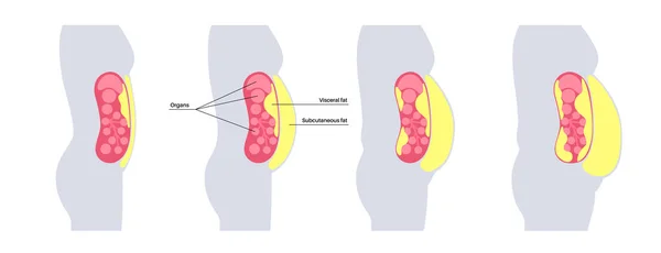 Вісцеральний Жирний Медичний Плакат Жир Оточує Внутрішні Органи Черевної Порожнини — стоковий вектор