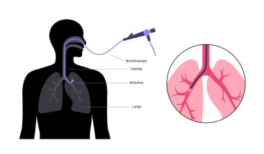 Bronkoskopi prosedürü. Pulmonolog ağızdan akciğere doğru bronkoskop kullanıyor. Solunum sistemi hastalıkları ve tedavisi. Endobronşiyal ultrason bronkoskopi tanısal vektör çizimi.