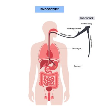 Gastroskopi prosedürü. Gastroenterolog gastroskop kullanıyor. Mide ve bağırsak teşhisi. Gastroenteroloji, endoskopi ve mide hastalıkları. Sindirim sistemi problemi ve tedavi vektörü