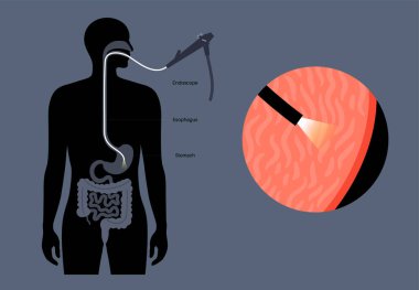 Gastroskopi prosedürü. Gastroenterolog gastroskop kullanıyor. Mide ve bağırsak teşhisi. Gastroenteroloji, endoskopi ve mide hastalıkları. Sindirim sistemi problemi ve tedavi vektörü