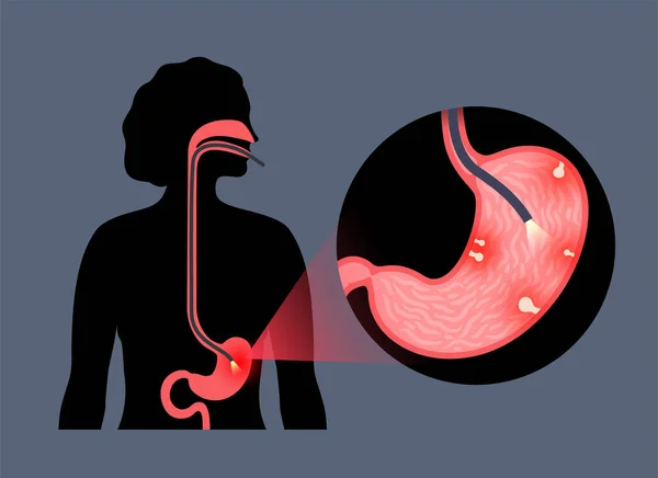 占星术程序 胃息肉诊断 胃肠学家使用胃镜 内窥镜的概念 胃肠学 胃肠道炎症 消化道疾病和治疗 — 图库矢量图片
