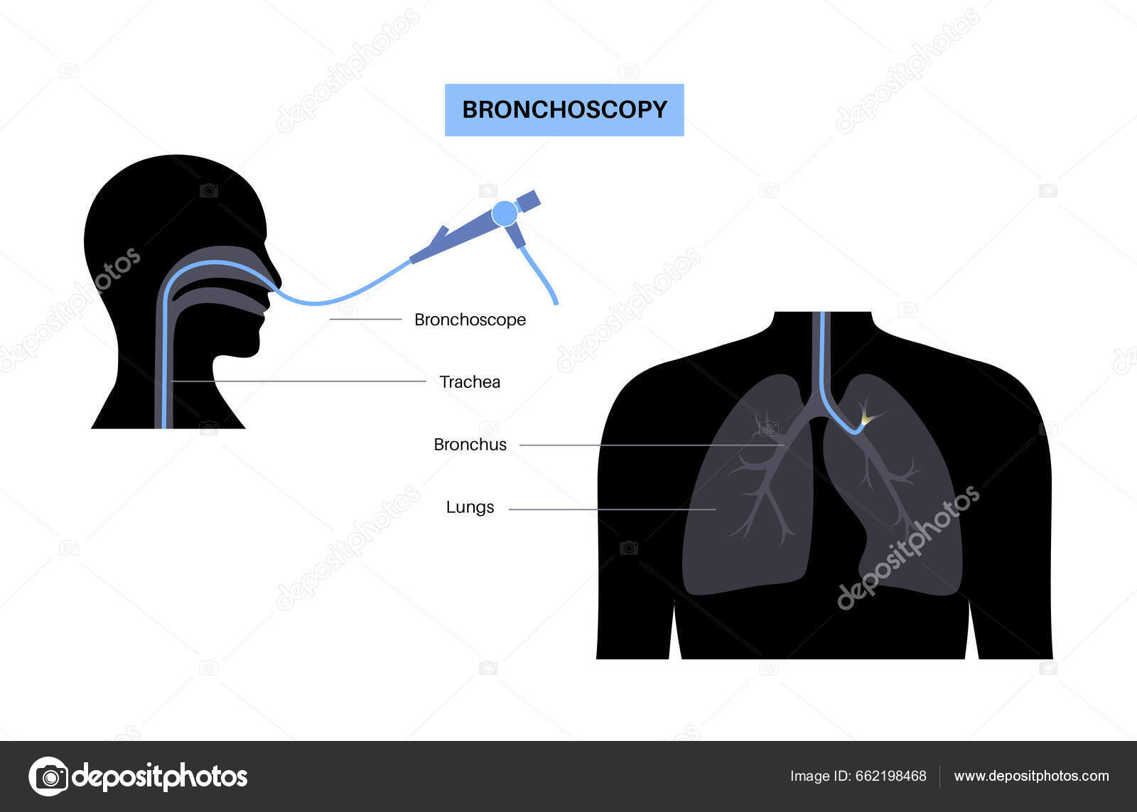 Prosedur Bronchoscopy Pulmonologis Menggunakan Bronkoskop Melalui Mulut Dalam Paru Paru Vektor
