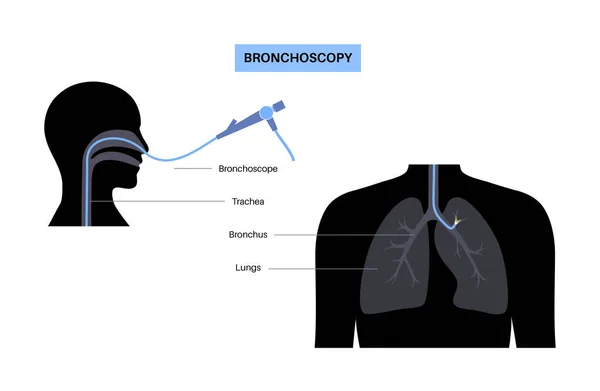 Bronchoscopie Procedure Pulmonoloog Gebruikt Een Bronchoscoop Mond Long Ziekten Van — Stockvector
