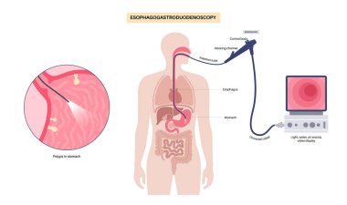 Gastroskopi prosedürü. Mide polipsi teşhisi. Gastroenterolog gastroskop kullanıyor, endoskopi konsepti. Gastroenteroloji, mide iltihabı. Sindirim sistemi hastalığı ve tedavisi