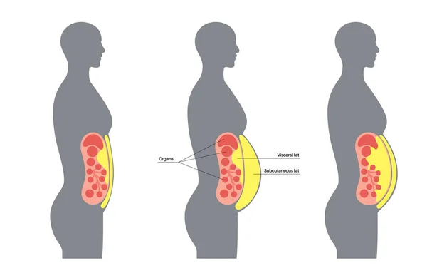 内臓脂肪医療ポスター 腹脂肪は腹腔内の臓器を取り囲みます 太りすぎの病気の概念 脂肪吸引と食事 肥満人間のシルエットフラットベクトルイラスト — ストックベクタ