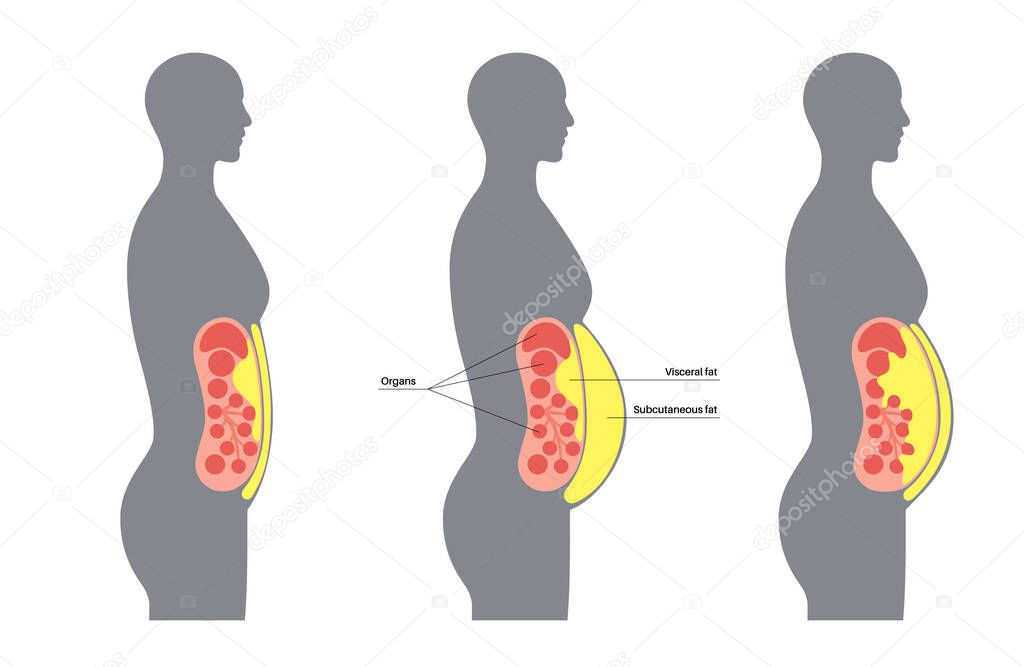 Cartel Médico Grasa Visceral Grasa Del Vientre Rodea Los Órganos