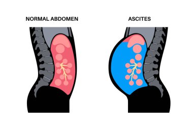Asitlerin anatomisi. Periton boşluğunda sıvı var. Karın şişkinliği, ağrı, şişkinlik ve mide bulantısı. Karın, organlar ve iç organlarda basınç. Gastrobağırsak yolu. Abdominopelvic oyuk vektör çizimi