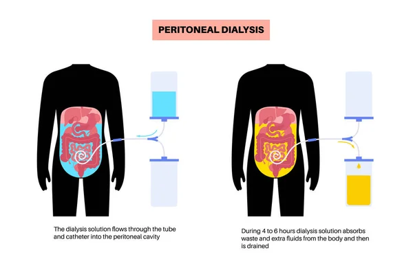 Peritonealdialys Vätska Bukhålan Peritoneum Buken Ämnen Utbyts Med Blod Mjukt — Stock vektor