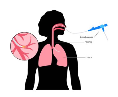 Bronkoskopi prosedürü. Pulmonolog ağızdan akciğere doğru bronkoskop kullanıyor. Solunum sistemi hastalıkları ve tedavisi. Endobronşiyal ultrason bronkoskopi tanısal vektör çizimi.