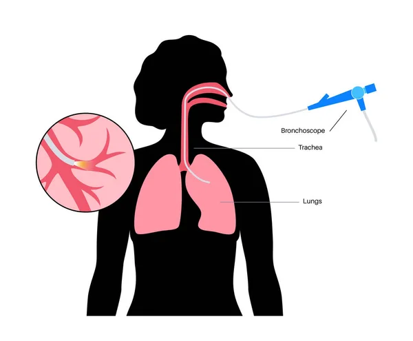 Bronchoskopický Zákrok Plicní Lékař Používá Bronchoskop Ústy Plic Onemocnění Dýchacích — Stockový vektor