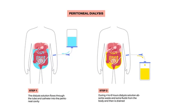 腹膜透析程序 腹腔内的液体 腹膜在腹部 物质与血液交换 软管在人体 导管的概念 从腹部取出多余的液体 — 图库矢量图片