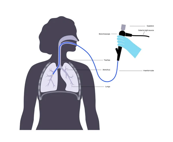 Procédure Bronchoscopie Pneumologue Utilise Bronchoscope Par Bouche Jusqu Poumon Maladies — Image vectorielle