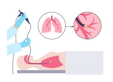 Bronkoskopi prosedürü. Pulmonolog ağızdan akciğere doğru bronkoskop kullanıyor. Solunum sistemi hastalıkları ve tedavisi. Endobronşiyal ultrason bronkoskopi tanısal vektör çizimi.
