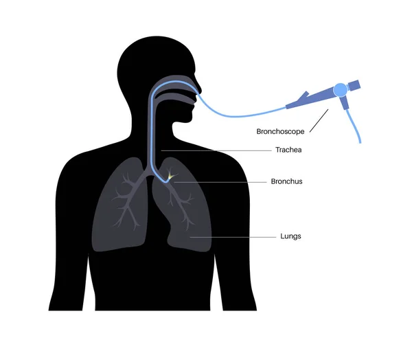 気管支鏡検査手順 肺腫瘍学者は肺に口から気管支鏡を使用しています 呼吸器系疾患や治療 内視鏡超音波気管支鏡検査ベクトル図 — ストックベクタ