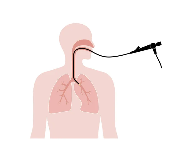 Bronchoskopie Verfahren Pneumologe Verwendet Ein Bronchoskop Durch Den Mund Die — Stockvektor