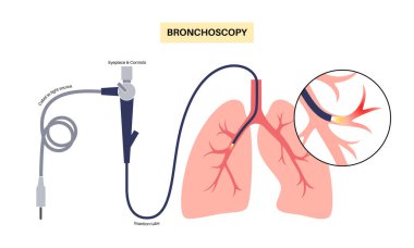 Bronkoskopi prosedürü. Pulmonolog nefes borusundan akciğere bronkoskop kullanıyor. Solunum sistemi hastalıkları ve tedavisi. Endobronşiyal ultrason bronkoskopi tanısal vektör çizimi