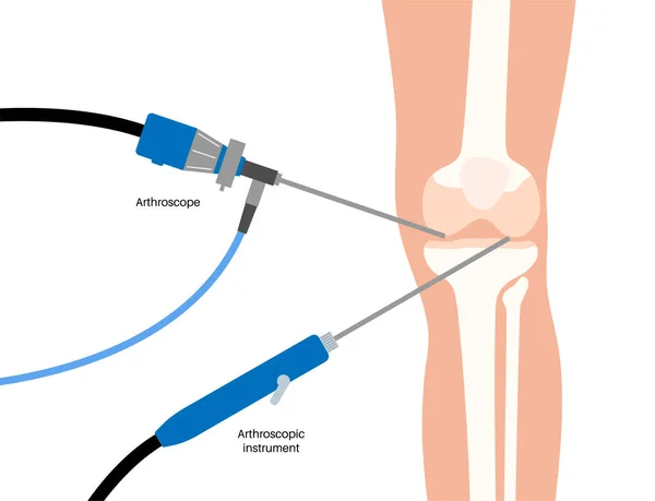 stock vector Arthroscopy medical procedure. Knee joint minimally invasive surgery. Arthroscope and arthroscopic instrument. Patella treatment, leg pain, kneecap inflammation. Ligament and meniscus anatomy vector.