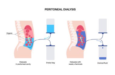 Peritoneal dialysis procedure. Fluid in peritoneal cavity. Peritoneum in the abdomen, substances are exchanged with blood. Soft tube in human body, catheter concept. Remove excess fluid from belly clipart
