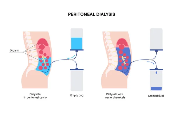 Peritoneális Dialízis Folyadék Hasüregben Peritoneum Hasüregben Anyagok Cserélődnek Vérrel Puha — Stock Vector