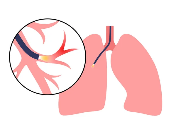 気管支鏡検査手順 肺腫瘍学者は 気管を通って肺に気管支鏡を使用します 呼吸器系疾患や治療 内視鏡超音波気管支鏡検査ベクトル図 — ストックベクタ