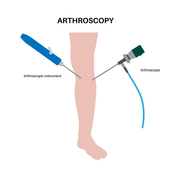 Artroscopia Procedura Medica Chirurgia Minimamente Invasiva Delle Articolazioni Del Ginocchio — Vettoriale Stock
