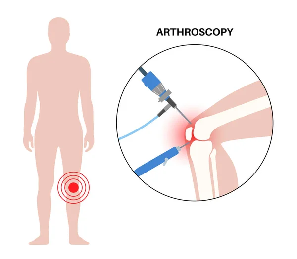 Artroskopi Tıbbi Prosedürü Diz Eklemi Minimal Invaziv Ameliyat Artroskop Artroskopik — Stok Vektör