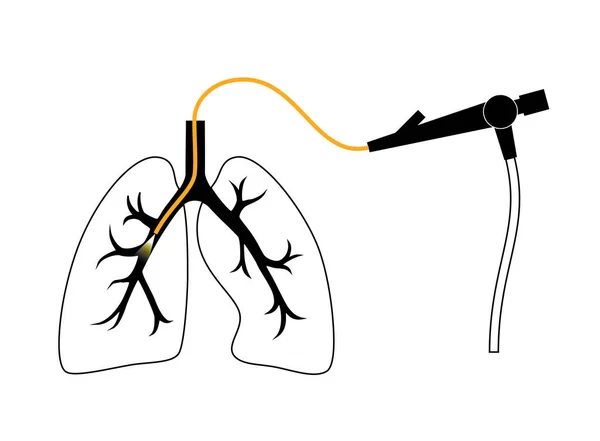 支气管镜检查肺病学家用支气管镜通过气管进入肺 呼吸系统疾病和治疗 鼻内膜超声支气管镜检查诊断载体示意图 — 图库矢量图片