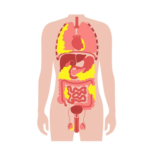 Медицинский Плакат Висцеральным Жиром Жир Живота Окружает Внутренние Органы Брюшной — стоковый вектор